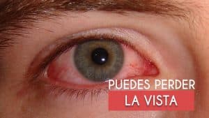 21 Enfermedades de los ojos más comunesSíntomas y Tratamiento