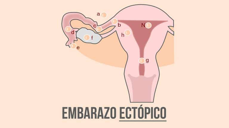 Embarazo ectópico Qué es Causas Síntomas y Tratamiento