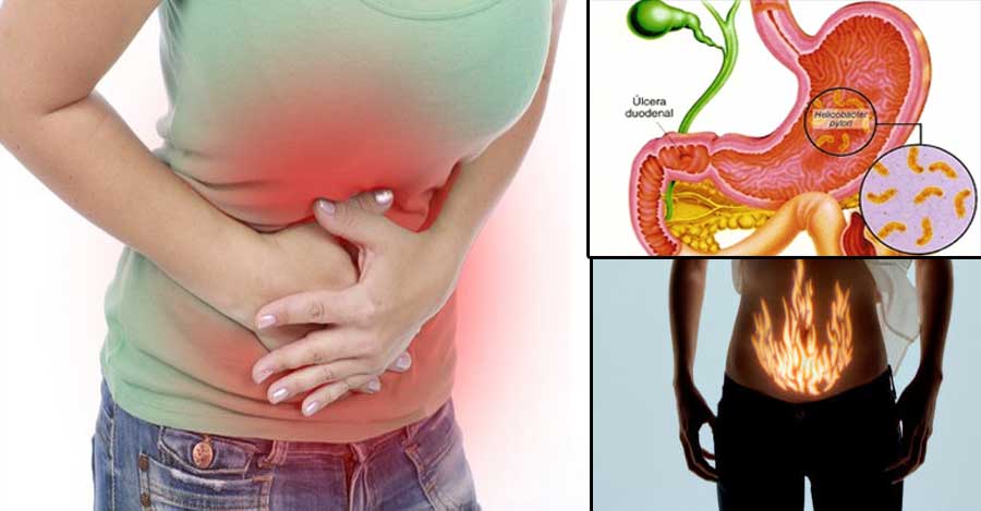 Gastritis síntomas