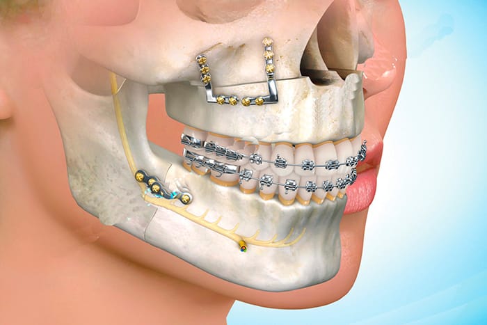 cirugia de mandibula