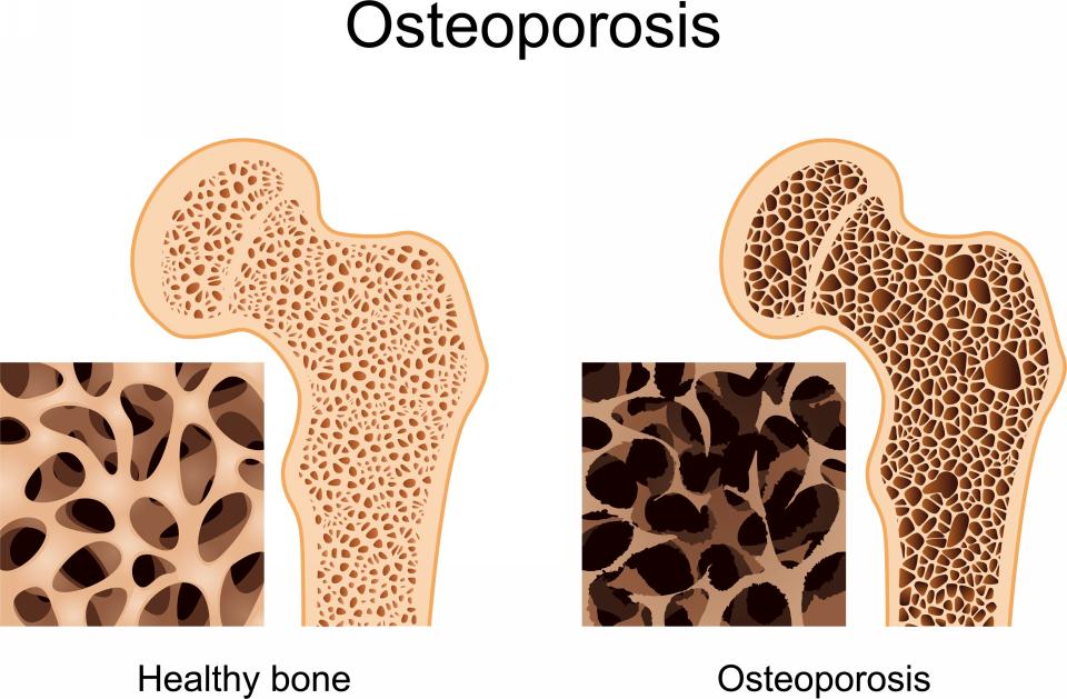 Hueso sano vs hueso con osteoporosis