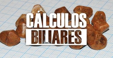 CALCULOS BILIARES